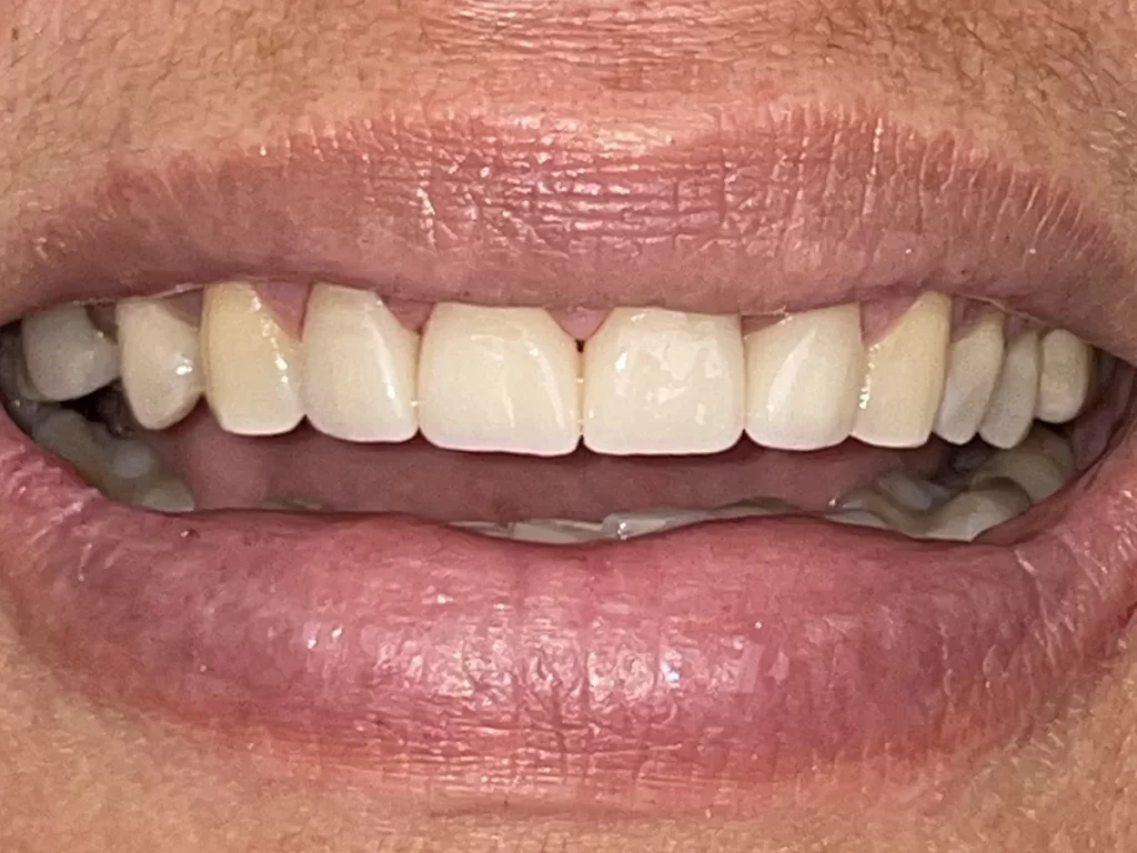 Crowns at Luxe Smiles, Palmetto Bay, Miami